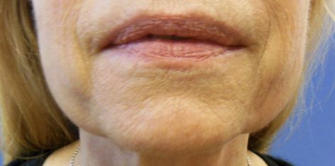 What Causes Jowls & How to Get Rid of Them Jowl Exercises, Facial Exercises For Jowls, Get Rid Of Jowls, Saggy Face, Facelift Surgery, Sagging Cheeks, Sagging Face, Saggy Neck, Face Lift Surgery