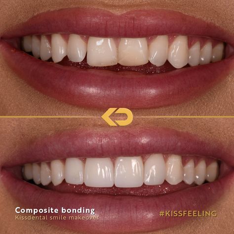 Edge Bonding Teeth, Composite Bonding Before And After, Composite Bonding Teeth, Teeth Makeover, Teeth Bonding, Composite Bonding, Misaligned Teeth, Composite Veneers, Pretty Teeth