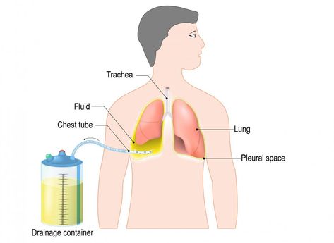 Chest tube insertion: Uses, procedure, and recovery Chest Tube Insertion, Collapsed Lung, Chest Tube, Pleural Effusion, General Anaesthesia, Chest Muscles, Scar Tissue, Surgical Instruments, Chest Pain