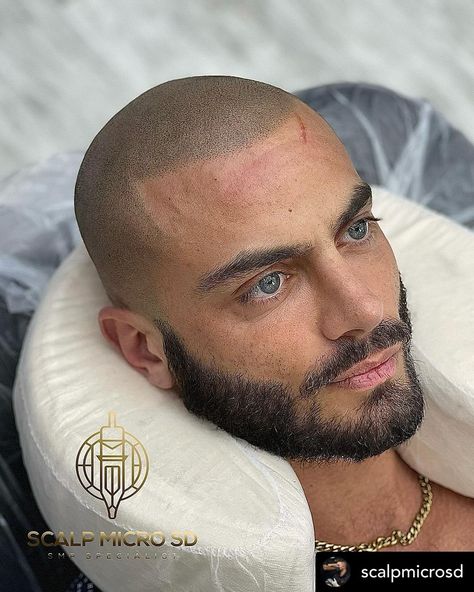 Nice work by @scalpmicrosd with a bold, defined yet natural looking result 🖤 #scalpmicropigmentation Micro Scalp Pigmentation, Bald Men Style, Scalp Micropigmentation, Bald Men, Hairstyles And Haircuts, Men's Hairstyles, Hair And Beard Styles, Love Hair, Cortes De Cabello