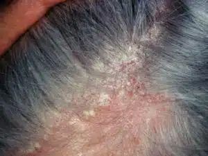 Seborrhoeic dermatitis in adults - National Eczema Society Hair Diseases, Diseases And Disorders, Nike Trainer, Androgenetic Alopecia, Black Seed Oil, Skin Disorders, Holistic Nutrition, Homemade Remedies, Health Is Wealth