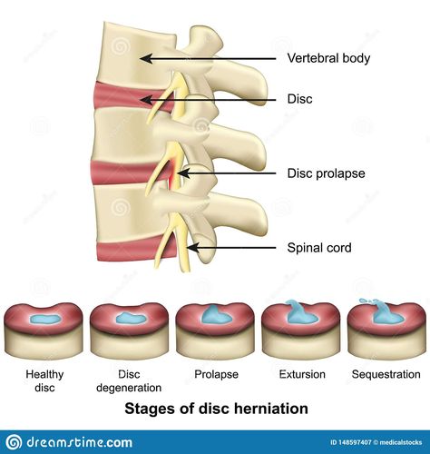 Stages+of+disc+herniation+spine+and+disc+anatomy+3d+medical+vector+illustration+eps+10 Disc Herniation Exercises, Disc Disease Degenerative, Degenerative Lumbar Disc Disease, Degenerating Disc Disease, Disc Herniation, Medical Vector, Intervertebral Disc, Disk Herniation, Pta School