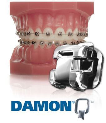 Treat yourself to a Damon smile at Alizadeh & Schreiner Orthodontics Damon Braces, Adult Braces, Teeth Braces, Great Smiles, Treat Yourself, Braces