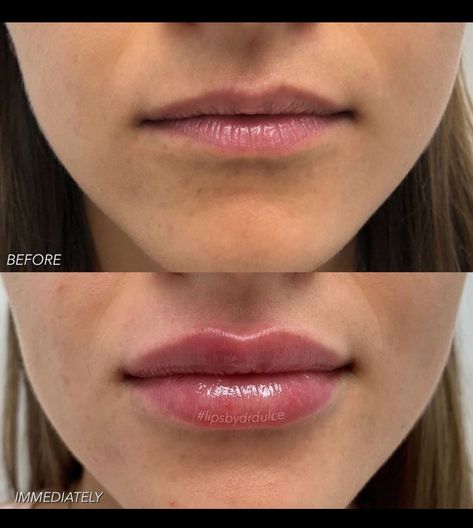 Lip Filler Half Syringe, Downward Turned Lips, 1ml Lip Filler Before And After, Bad Lip Filler, 1 Ml Lip Filler Before And After, Pouty Lip Filler, 0.5ml Lip Filler Before And After, Lip Filler After Care, Lip Injections Before And After