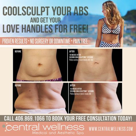 Interested in #CoolSculpting? Now is the time to get FABULOUS results with our new special ➡️ Buy your abs and get your love handles for FREE! #freezeyourfat #summerbody #confidence #bikiniready #shortsseason Cool Sculpting, Beauty Therapy, Love Handles, Now Is The Time, Summer Body, Body Sculpting, Body Contouring, Pain Free, Surgery