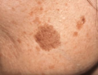 Simple Trick to Remove Brown Spots from Your Skin | TipHero Liver Spot, Age Spots On Face, Remove Skin Tags Naturally, Brown Age Spots, Age Spot Removal, Upper Lip Hair, Brown Spots On Skin, Spots On Skin, Age Spot