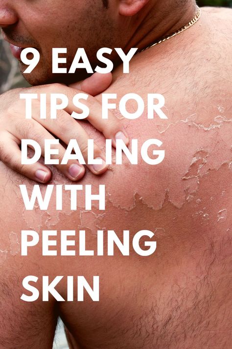 Peeling Skin From Sunburn How To Remove, Why Is My Skin Peeling, Sunburn Skin Peeling Remedies, How To Get Rid Of Peeling Skin On Face, How To Get Rid Of Peeling Skin Sunburn, Sunburn Peeling Remedies, Face Peeling From Sunburn, Skin Peeling From Sunburn, Sunburn On Face