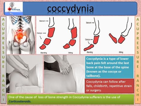 Acupressure & Natural Therapy: Coccydynia Tailbone Stretches, Coccyx Injury, Coccyx Pain Relief, Nerve Pain Remedies, Referred Pain, Pain Relief Remedies, Deep Massage, Nerve Pain Relief, Sciatic Nerve Pain