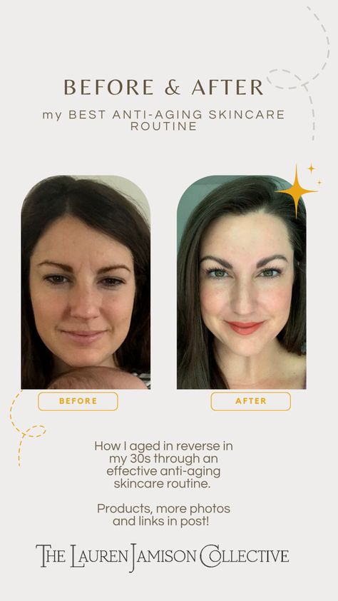 Before and After Anti-Aging Skincare Routine. How I aged in reverse in my 30s using a trifecta of anti-aging skincare products in combination with botox and dysport. Learn about vitamin C serum for anti-aging, retinol vs retinoid, and why sunscreen is the best anti-wrinkle cream there is! In My 30s, My 30s, Acne Prone Skin Care, Dermatologist Recommended Skincare, Lotion For Oily Skin, Top Anti Aging Products, Anti Aging Skincare Routine, Eye Skin Care, Natural Acne Remedies