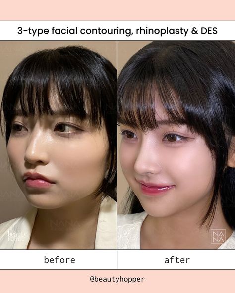 👉🏻Whether you are seeking a subtle refinement or a more dramatic transformation, we can guide you to the best surgeon capable of achieving the aesthetic you desire. Patient had: ✅Rhinoplasty ✅Cheekbone reduction ✅Chin genioplasty ✅Jaw reduction ✅Incisional double eyelid with ptosis correction We’re here to help you have a safe and successful makeover in Korea. Contact us for a free consultation ⬇️⬇️⬇️ 💌: contact@beautyhopper.com 📲: WhatsApp: +(82)1098587703 OUR SERVICES INCLUDE: 🩺 Doc... Square Jaw Reduction, Jaw Shaving Surgery, Chin Reduction Surgery, Chin Reduction, Plastic Surgery Korea Before After, Jaw Surgery Before And After Overbite, Kpop Plastic Surgery, Corrective Jaw Surgery, Jaw Reduction Surgery