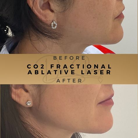 Transform your skin with the power of CO2 fractional laser! Say goodbye to dullness, wrinkles, and uneven skin tone. #CO2FractionalLaser #SkinRejuvenation #ScarReduction #WrinkleFree #GlowingSkin #skinhealth #skinclinic #skintreatment #skincareclinic #medspa #skinspecialist #loveyourskin #skincaretreatment #drsknn Laser Skin Care, Scar Reduction, Fractional Laser, Laser Resurfacing, Advanced Skin Care, Sun Damaged Skin, Aesthetic Medicine, Skin Specialist, Skin Care Clinic