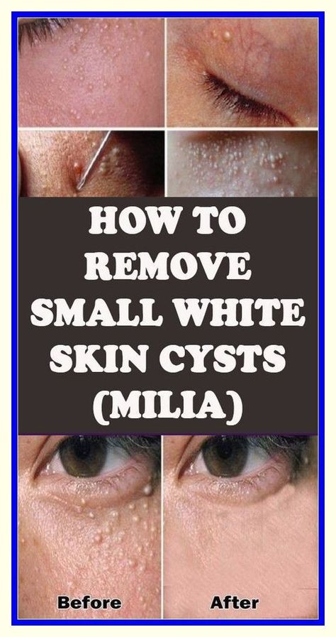 MILIA: HOW TO REMOVE THE SMALL WHITE SKIN CYSTS? Milia Removal, Medical Terms, Natural Health Tips, Health And Fitness Tips, Alternative Medicine, Health And Wellbeing, Healthy Tips, Keratin, Skin Cells