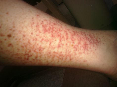 Petechiae - Symphtoms of hemorhagic spots Red Skin Spots, Red Rash, Itchy Rash, Blood Vessels, Dermatology, Disease, Dots, Skin, Red