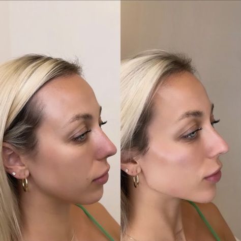 Full Face transformation Jawline contour Cheek filler Jawline contour Before and after Contouring Before And After, Full Face Fillers Before And After, Jawline Fillers Before And After, Full Face Contour, Jawline Contour, Face Dermal, Face Transformation, Under Eye Fillers, Face Fillers