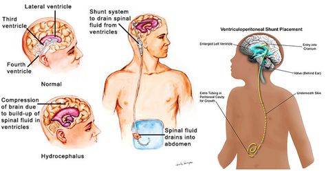 Great website about spina bifida! Spina Bifida Awareness Month, Vp Shunt, Spina Bifida Awareness, Intracranial Pressure, Spinal Fluid, Muscular Dystrophy, Spina Bifida, Cerebrospinal Fluid, Nursing Career