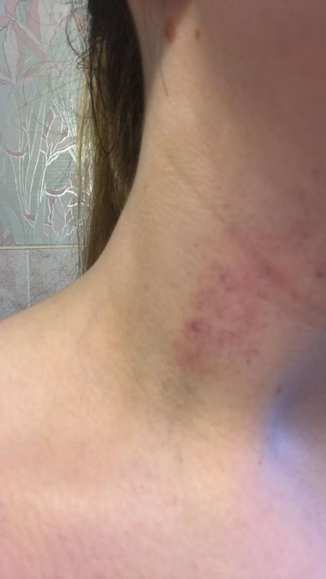 Before Love Bites Dpz, Love Bite Photos Aesthetic, Love Bite Photos Real, Hickey Neck Aesthetique, Love Bite Snap, Love Bites Hickey, Neck Full Of Hickeys, Love Bite Photos, Hickies Neck Aesthetic