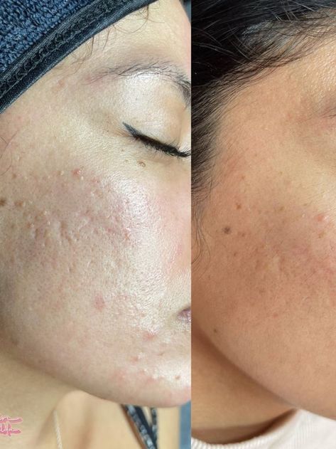 Before and After | Acne Free | Free The Pimple | Acne Positive | Acne Scars | Acne Acne Positive, Before And After Acne, How To Get Rid Of Pimples, Acne Solutions, Acne Free, Hair Stylist Life, Beauty Studio, Beauty Cosmetics, Clear Skin