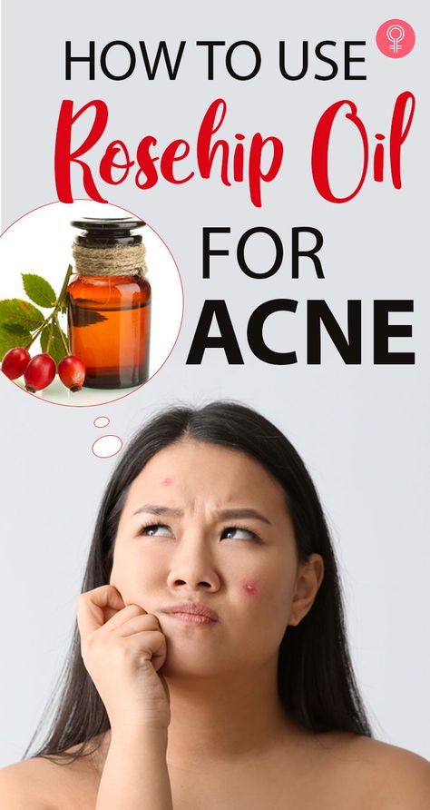 How To Use Rosehip Oil For Acne: Rosehip oil (or rosehip seed oil) is claimed to be effective in acne management. This article explores the truth behind the claim, other skin benefits of rosehip oil, and ways to use it. Keep reading. #skincare #acne #rosehip #skin Coconut Oil For Tanning, Benefits Of Rosehip Oil, Rosehip Oil Benefits, Skincare Acne, Rosehip Seed Oil, Acne Breakout, Skin Pores, Facial Moisturizers, Skin Benefits