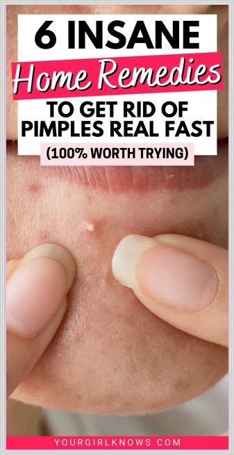 How to Get Rid of Pimples Overnight Get Rid Of Back Acne, Rid Of Back Acne, Skin Treatments For Acne, Clear Pimples, Get Rid Of Pimples Overnight, Back Acne Remedies, Covering Acne, Treatments For Acne, Different Types Of Acne