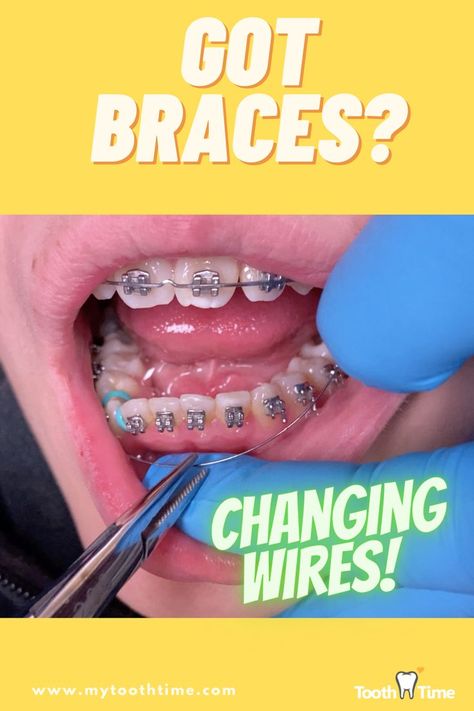 9 months progress! check the video out! :) White Out Tape, Braces, Blog Posts