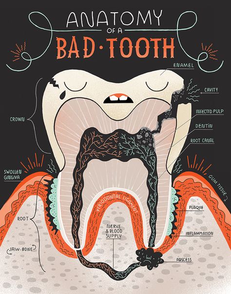 Inside a bad tooth by Rachel Ignotofsky www.rachelignotofskydesign.com Dental Assistant Study, Teeth Anatomy, Dental Hygiene School, Teeth Art, Dental Anatomy, Kedokteran Gigi, Dental Fun, Bad Teeth, Nice Teeth