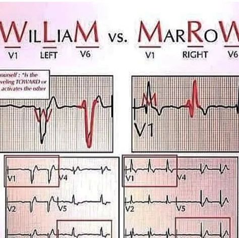 HouseOfMedicalKNLWandSkills on Instagram: "#ECG #LBBB #RBBB  Difference between Left Bundle Branch Block(LBBB) and Right Bundle Branch Block(RBBB) .  ***If the QRS complex is widened and downwardly deflected in lead V1, a left bundle branch block is present. If the QRS complex is widened and upwardly deflected in lead V1, a right bundle branch block is present. The image below shows the changes in lead V1 and lead v6 for RBBB and LBBB.  ➡️Left Bundle Branch Block ECG criteria:  1) QRS duration of > 120 ms 2) Dominant S wave in V1 3) Broad monophasic R wave in lateral leads (I, aVL, V5-V6). 4) Absence of Q waves in lateral leads (I, V5-V6; small Q waves are still allowed in aVL). 5) Prolonged R wave peak time > 60ms in left precordial leads (V5-6).  ➡️ Right Bundle Branch Block ECG Criteria Left Bundle Branch Block, Nursing Knowledge, Doctor Stuff, Bundle Branch Block, Heart Stuff, Nurse Rock, General Surgery, S Wave, Never Stop Learning