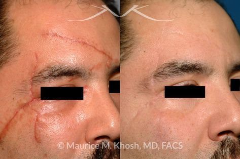 Scar Reference, Scar Revision, Hypertrophic Scars, Facial Scars, Facial Plastic Surgery, Architecture Design Drawing, Facial Plastic, After Pictures, Before And After Pictures