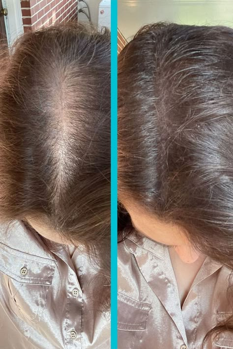 Before and after SureThik Hair Fibers, the difference says it all 😍⁠ SureThik Hair Fibers deliver instant volume and thickness making your hair look fuller in seconds. Get ready to rock your best hair day, every day! ⁠ Castor Hair Oil, Growth Supplements, Split End, Thicker Fuller Hair, Gothic Hairstyles, Hair Fixing, Castor Oil For Hair, Stronger Hair, Hair Thinning