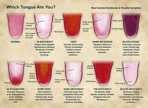 Traditional Chinese Medicine Tongue Diagnosis Charts - Imgur Nutrition Nursing, Qi Deficiency, Tongue Health, Medical Facts, Health Guide, Holistic Nutrition, Traditional Chinese Medicine, Eat Healthy, Chinese Medicine