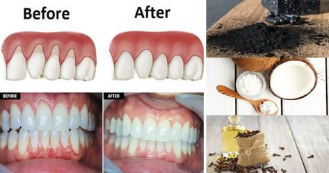 Grow Back Receding Gums, Sensitive Teeth Remedy, Remedies For Tooth Ache, Swollen Gum, Healthy Gums, Gum Recession, Loose Tooth, Teeth Health, Gum Care