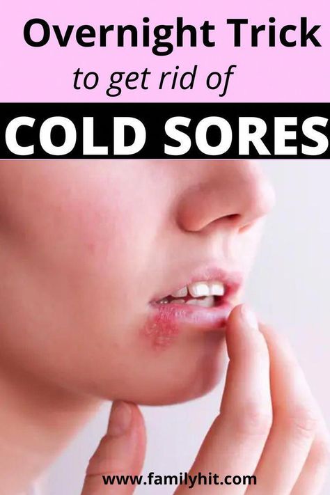 Natural Fever Blister Remedies, Lip Blister Remedy How To Get Rid, Essential Oil For Fever Blister On Lip, Doterra Cold Sore Remedy, Fast Cold Sore Remedy, How To Get Rid Of A Cold Sore Overnight, Heal Fever Blister Fast, Home Remedy For Fever Blister, Tea Tree Oil For Cold Sores