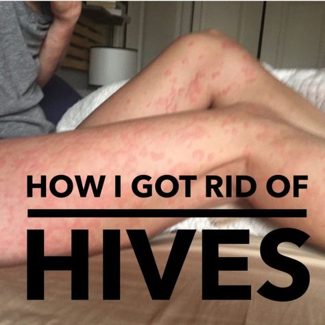 Essential Oil For Hives, Allergy Hives, Home Remedies For Hives, Hives Remedies, Chronic Hives, Rashes Remedies, Sinus Infection Remedies, Histamine Intolerance, Natural Remedies For Allergies