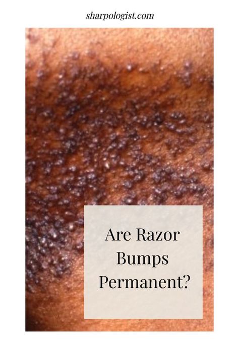 How to get rid of ingrown hairs, razor bumps, scars and dark spots EASY! Razor Bumps On Private Area, How To Get Rid Of Razor Bumps, Razor Bumps Remedy, Get Rid Of Ingrown Hairs, Best Permanent Hair Removal, Razor Bump, Treat Ingrown Hair, Permanent Hair Removal Cream, Shaving Bumps