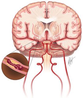 Clot-busting Drug Tissue Plasminogen Activator (tPA) For Stroke Patients Safe To Use With Blood Thinner Warfarin Intracranial Hemorrhage, Subarachnoid Hemorrhage, Types Of Strokes, Intracranial Pressure, Cerebrospinal Fluid, Severe Headache, Neurology, Clinical Trials, Blood Vessels