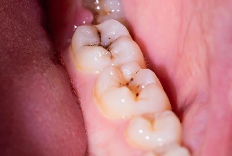 Dental Sealants, Dental Plaque, Dental Cavities, Tooth Sensitivity, How To Prevent Cavities, Alternative Treatments, Dental Hygiene, Tooth Decay, Mouthwash