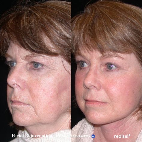 Get Rid Of Jowls, Facelift Recovery, Facial Before And After, Nonsurgical Nose Job, Face Plastic Surgery, Skin Tightening Procedures, Face Lift Surgery, Types Of Skin, Crepey Skin