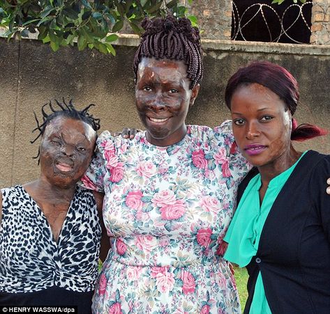 Inspirational: Acid victims Silvier Nambirige, Gloria Kankunda, director of the Center for Rehabilitation of Survivors of Acid and Burns Violence (CERESAV), and Linneti Kirungi, in Kampala, Uganda Three Months Pregnant, Burn Victims, Acid Attack, Kampala Uganda, Sally Nightmare Before Christmas, Brave Women, We Are The World, People Of The World, Womens Rights