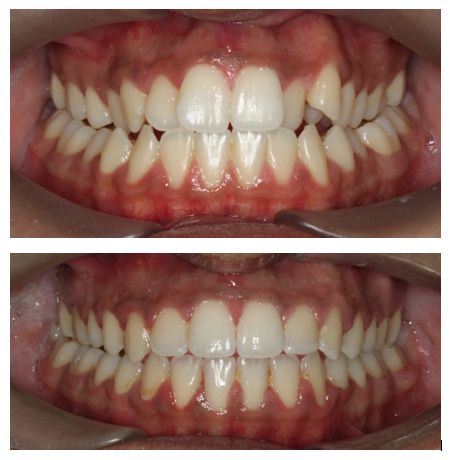 Before and after braces. Actual patient of Impressions Orthodontics. Before And After Braces, Dental Ceramics, After Braces, Invisalign Braces, Dental Posters, Orthodontics Braces, Dental Braces, Teeth Braces, Diy Birthday Gifts For Friends