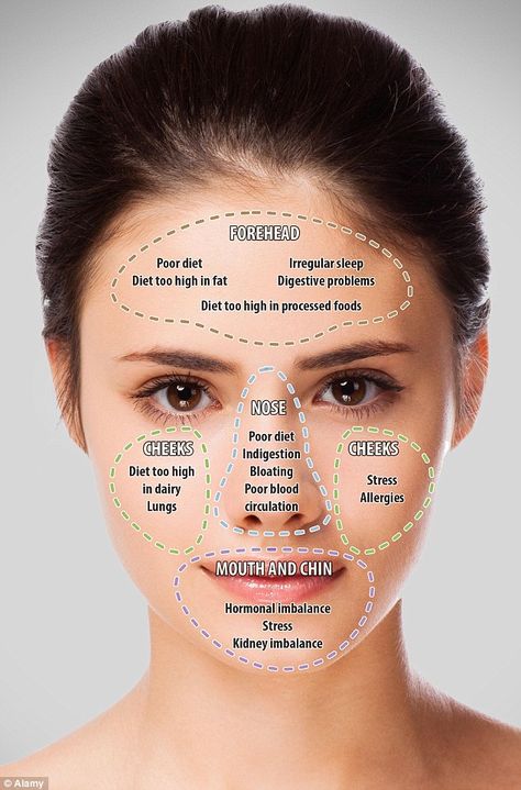 Doctor of traditional Chinese medicine and wellbeing expert, John Tsagaris, believes that breakouts on varioys areas of the face can reflect different problems in your internal health Doterra Acne, Gesicht Mapping, Acne Chart, Face Mapping Acne, Face Mapping, Face Tips, Face Reading, Face Acne, Acne Remedies