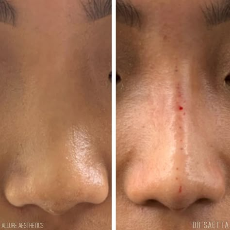 Nose Filler, Nose Surgery Rhinoplasty, Mini Face Lift, Nose Fillers, Bulbous Nose, Esthetician Inspiration, Facial Procedure, Rhinoplasty Nose Jobs, Botox Before And After