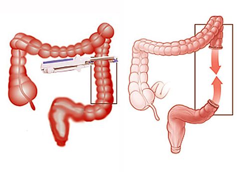 Colorectal surgeon Los Angeles  #colorectalsurgery #colorectalcancer Abdominal Surgery, Colon Health, Laparoscopic Surgery, Nursing Tips, Health Center, Health Conditions, Surgery, Health Care, Medical