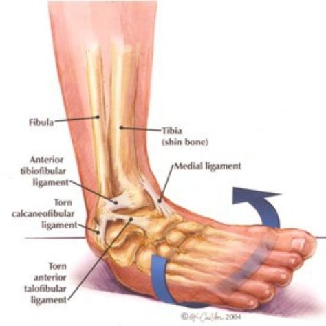 FRIDAY FOCUS - Spraining/tearing the lateral ligaments of the ankle (i.e. going over on the outside of your ankle) are among the most common injuries that people experience during sports. The most commonly injured ligament on the outside of the ankle is referred to as the anterior talofibular ligamental (ATFL) which is one of 3 main lateral ligaments. The ankle joint moves in many ways. During movement there is a degree of rolling and sliding that occurs. Ligaments on the outside of the ankl... Ankle Anatomy, Swollen Feet Remedies, Ankle Ligaments, Twisted Ankle, Feet Remedies, Ankle Sprain, Foot Anatomy, Ligament Tear, Ankle Pain