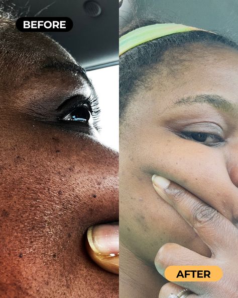 "My before and after pictures say it all. This soap is amazing. THANK YOU." 🙌🏾 Jeneta's results with turmeric soap show improved texture, fewer pimples, and fading dark spots. See for yourself what consistency can achieve! Turmeric Soap, After Pictures, Before And After Pictures, Dark Spots, Soap, Skin Care, Thank You, Texture, Skin