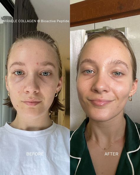 This is why we sold out—Miracle Collagen is truly transformative. The before and afters speak volumes. There’s nothing more rewarding than empowering our customers to feel confident and comfortable in their skin. Feel Confident, Skin, Feelings