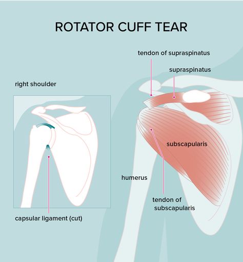 Rotator Cuff Injury: Treatments, Symptoms and Diagnosis Subscapularis Muscle, Rotator Cuff Muscles, Rotator Cuff Tear, Shoulder Impingement, Rotator Cuff Injury, Bicep Muscle, Muscle Atrophy, Back Stretches For Pain, Rotator Cuff