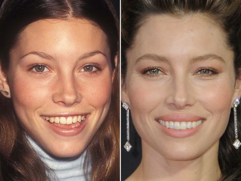 Jessica Biel Before and After - The Skincare Edit Jessica Biel Hair, Jessica Beil Hair, Jessica Biel Style, Plastic Surgery Before And After, Cheek Implants, Botox Lips, Plastic Surgery Gone Wrong, The Illusionist, Blonde Hair Makeup