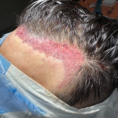 These are the hairline recipient sites for a FUE hair transplant. The Hairline is the most important place to make sure that you have a talented surgeon! The angle of the hair, depth, orientation and shape are all critical to a natural result. The Hairline is also the first thing everyone sees, and it is what YOU as the patient see every day! #hair4lifeazmedical #hair4lifeaz #drramonakelemen #fue #hairtransplant #fuehairtransplant #besthairtransplants Fue Hair Transplant, The Angle, The Patient, Hair Transplant, 2025 Vision, 4 Life, Cool Hairstyles, Vision Board, Every Day