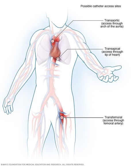 Transcatheter aortic valve replacement (TAVR) - Mayo Clinic Aortic Valve Replacement, Medical Device Design, Heart Valves, Acute Care, Heart Surgery, Medical Art, Devices Design, Mayo Clinic, Heart Healthy