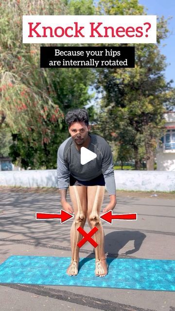 Fix Knock Knees Exercise, Correct Knock Knees Exercise, How To Fix Knock Knees, How To Get Rid Of Knock Knees, Knock Knees Exercises, Knock Knees, Yoga For All, Knee Exercises, Hip Openers