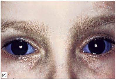 Blue Sclera In child with OI Blue Sclera, Osteogenesis Imperfecta, Bone Diseases, Blue, Quick Saves